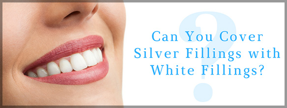 Can You Cover Silver Fillings With White Fillings?