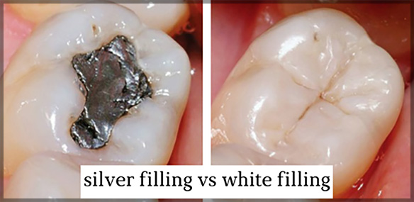 Silver Fillings vs White Fillings
