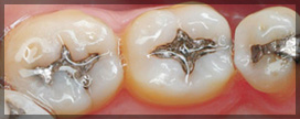 Three Teeth With Silver Fillings