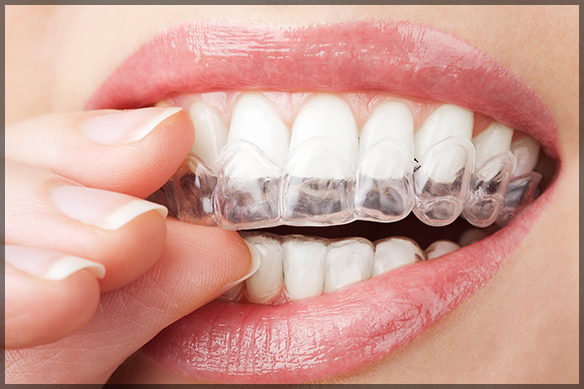 Dental Veneers