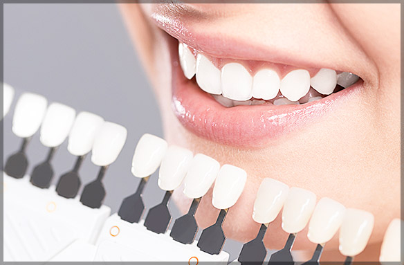 Why Professional Teeth Whitening is Worth It