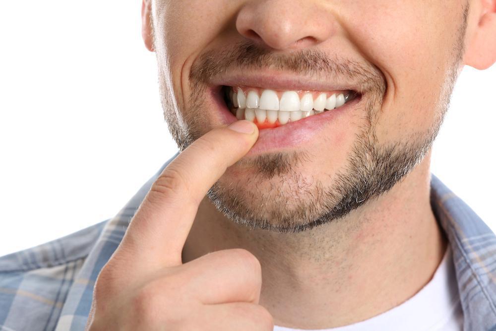 Preventing Gum Disease