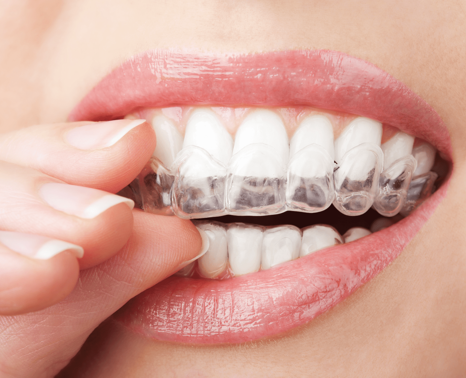 How Invisalign Can Benefit Your Children