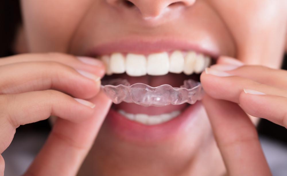 Invisalign