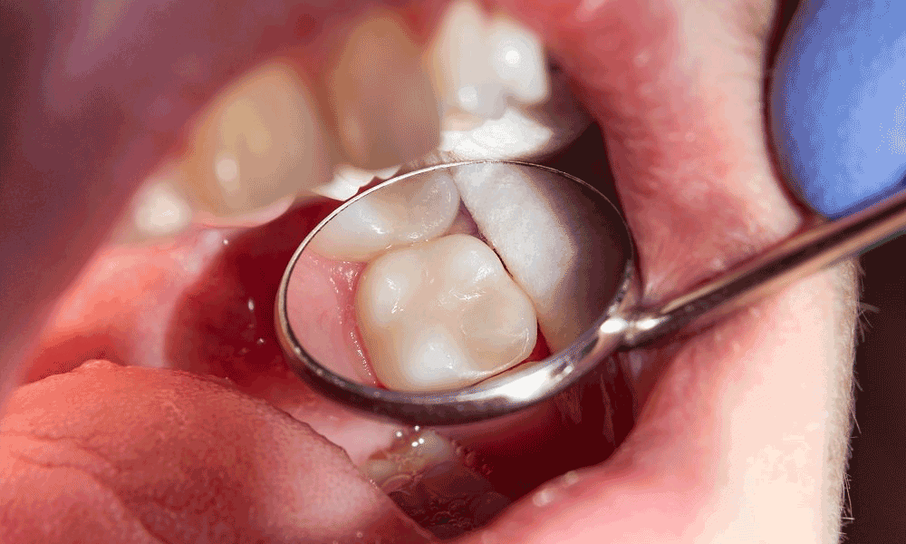 composite-tooth-filling